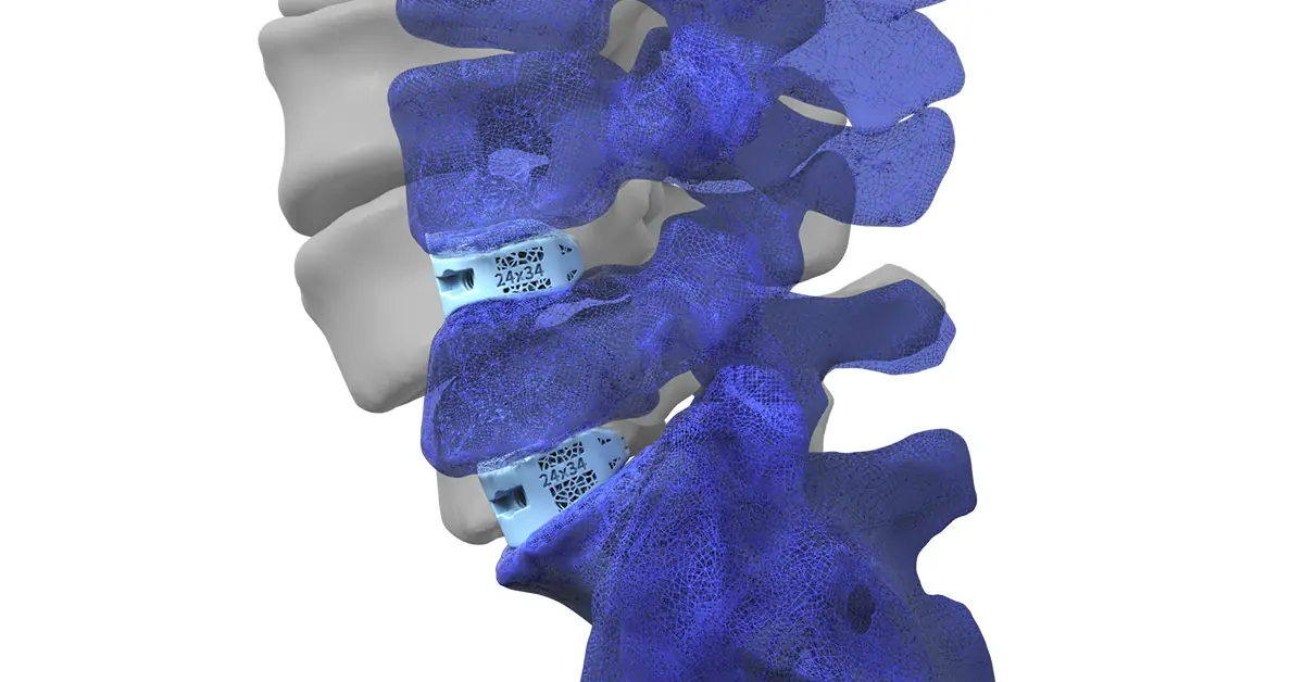 predictable intervertebral alignment