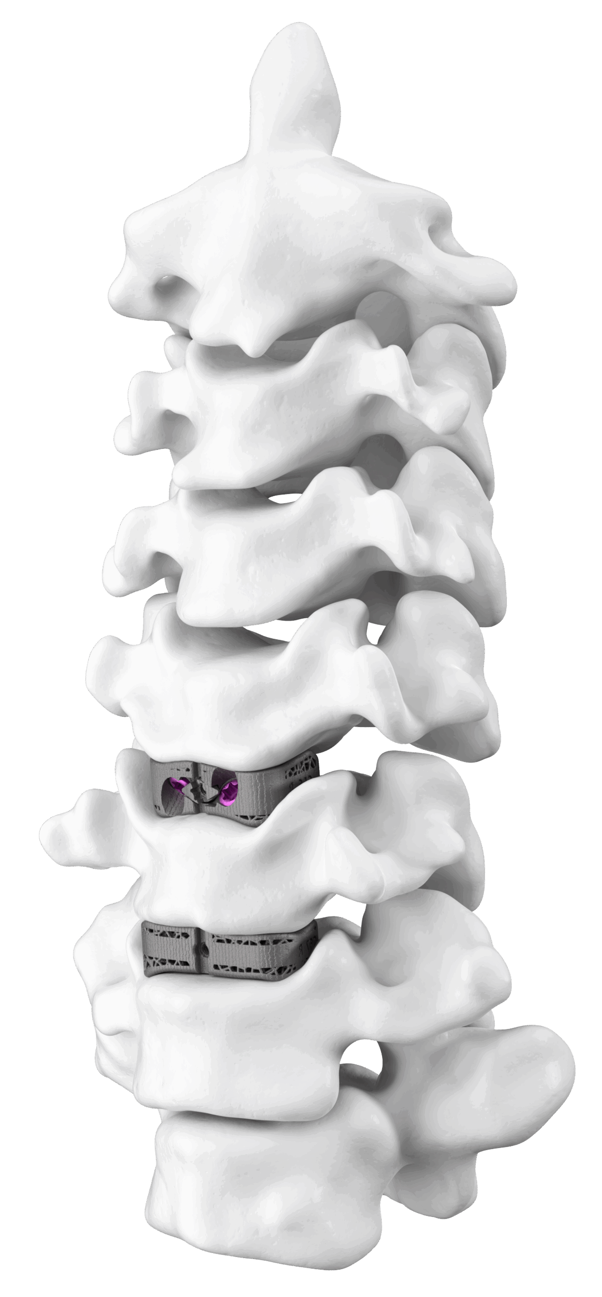cervical_2levels_web